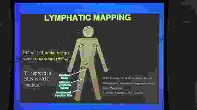 Sentinel Lymph Node Biopsy Oncologic Breast Surgery (Updates In Surgery)