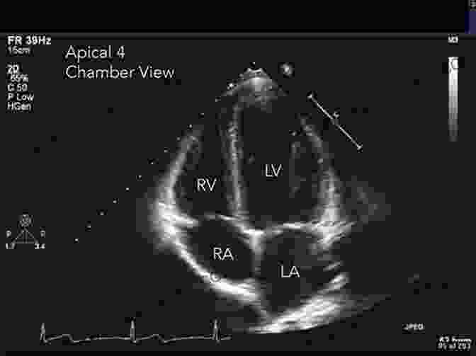 Ultrasound Image Of Heart With Labeled Structures Ultrasonography In The ICU: Practical Applications