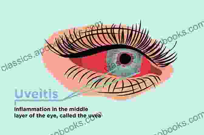 Uveitis Is A Condition That Causes Inflammation Of The Uvea, The Middle Layer Of The Eye. Uveitis: An Update Nils Norrsell