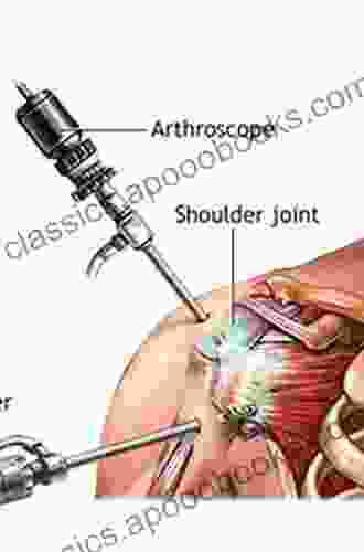 Advanced Techniques in Shoulder Arthroscopy