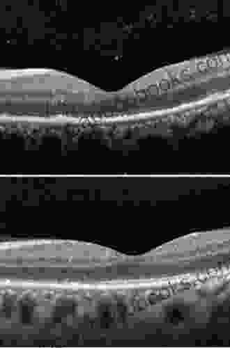 Uveitis: An Update Nils Norrsell